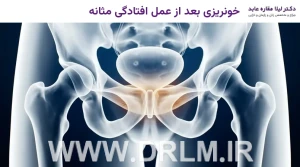 خونریزی بعد از عمل افتادگی مثانه