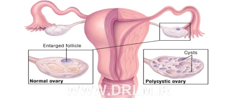 آیا کیست تخمدان دفع می شود؟