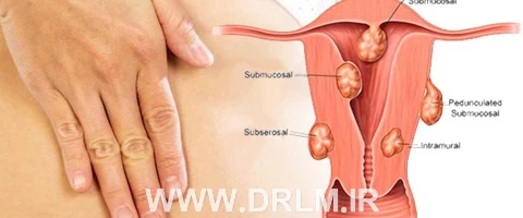 علت ایجاد فیبروم رحم چیست ؟