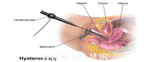 احتمال بارداری بعد از هیستروسکوپی