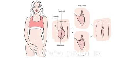هزینه عمل لابیاپلاستی چیست