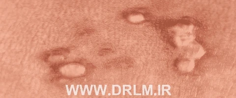 دکتر متخصص زگیل تناسلی در اصفهان
