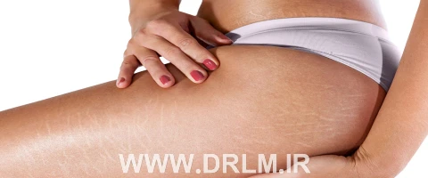 استریا چیست