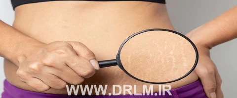 بهترین دکتر برای ترک های پوستی