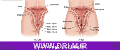 چگونه لابیا را کوچک کنیم