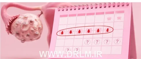 آیا تنبلی تخمدان باعث تأخیر در پریود می‌شود؟