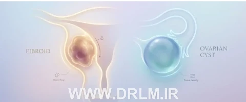 تفاوت فیبروم و کیست تخمدان